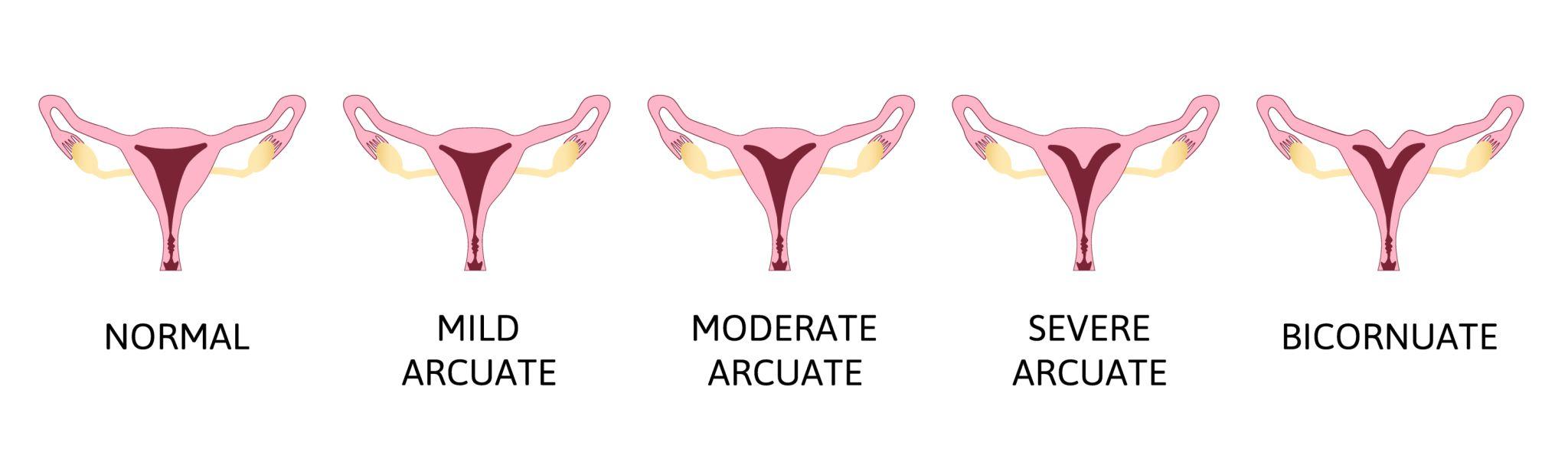 Laparoscopic Management of Septate or Bicornuate Uterus in Pune – Advanced Uterine Correction